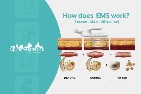 EMS treatment for post pregnancy weight loss treatment Sussex