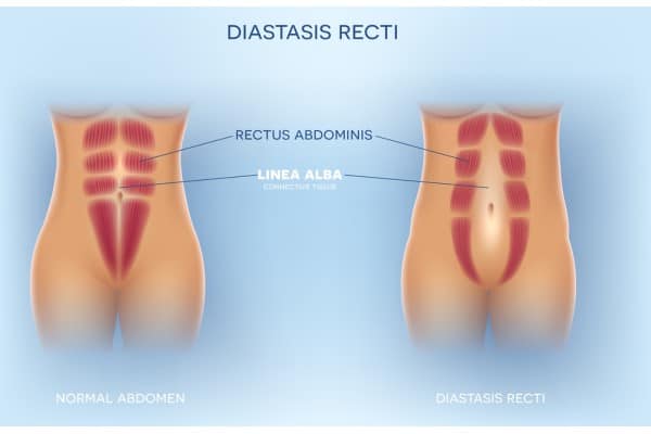What Non-Surgical Options Are Available for Diastasis Recti Sussex?