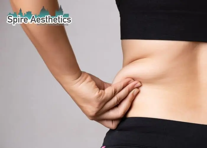 Image of woman pinching fat on their hips Sussex. Fat Freezing treatment