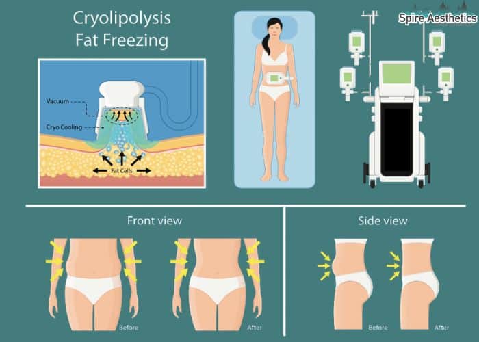 Image of diet and fat freezing combined for best results for Spire Aesthetics Sussex