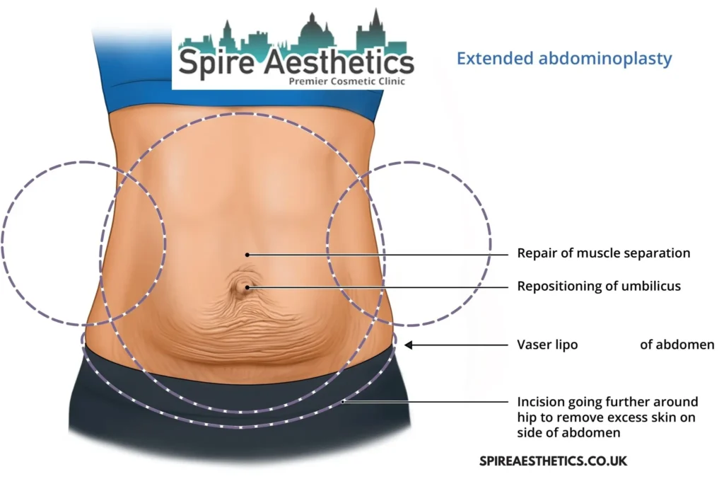 Understanding Loose Skin After Gastric Band Sussex Surgery and HIFU Treatment