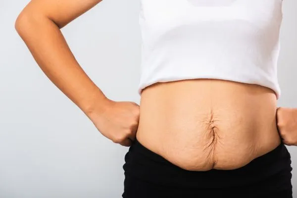 Image of a woman's stomach after weight loss with sagging skin following a gastric band Sussex