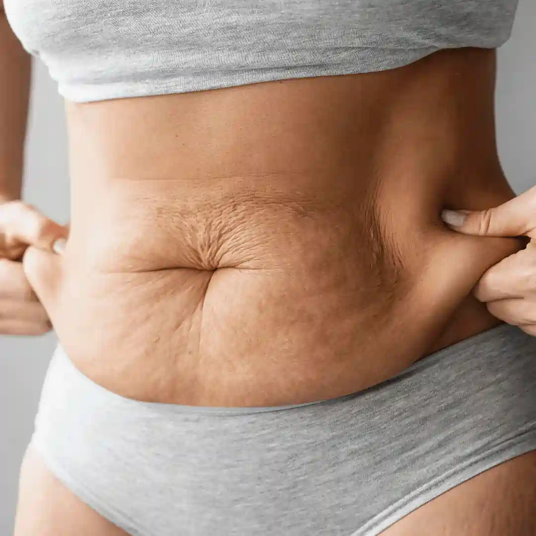 Is It Normal to Have Loose Skin After Pregnancy Sussex?