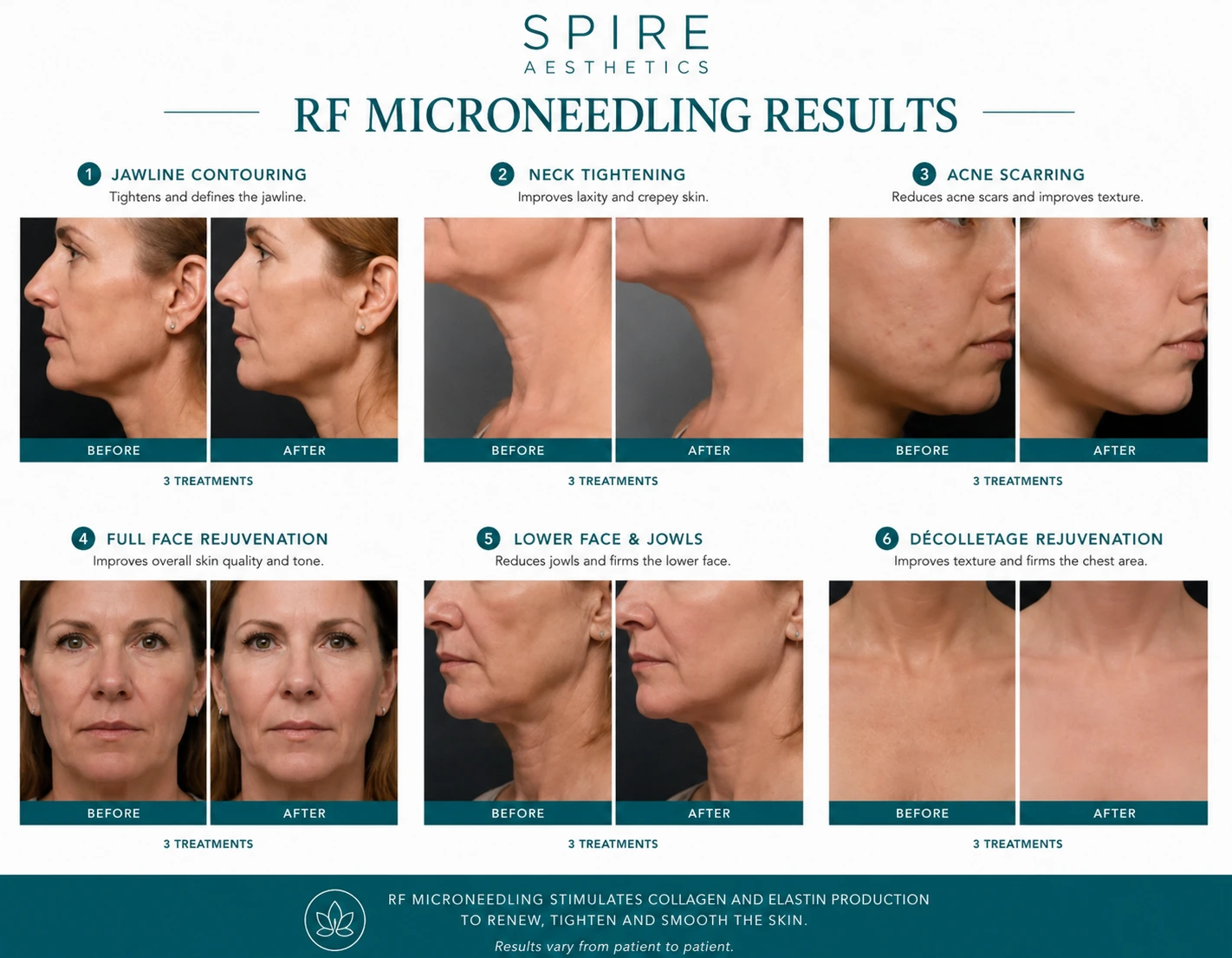 RF Microneedling Skin tightening Sussex results
