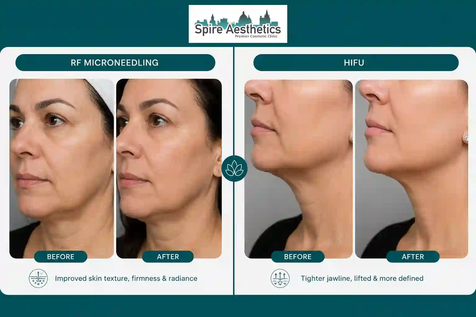Can RF Microneedling and HIFU Be Combined Sussex?