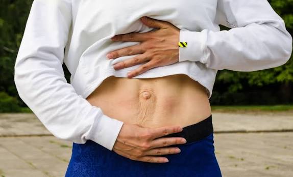 When Could Diastasis Recti Be the Missing Piece of the Puzzle Sussex?